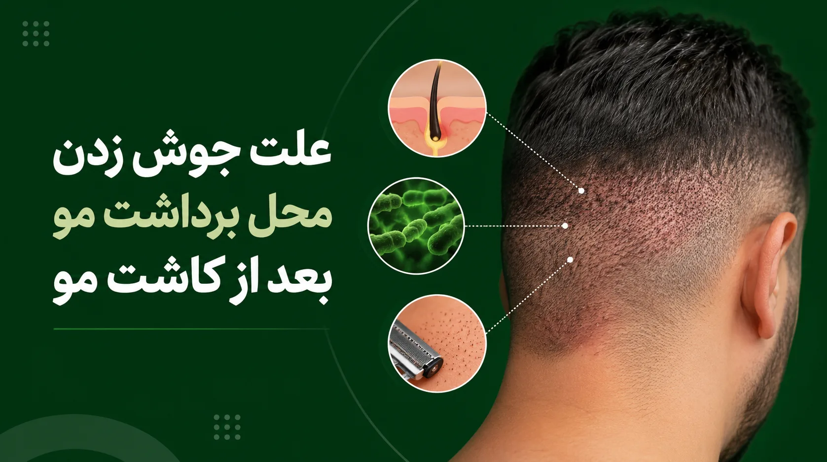 علت جوش زدن محل برداشت مو بعد از کاشت مو